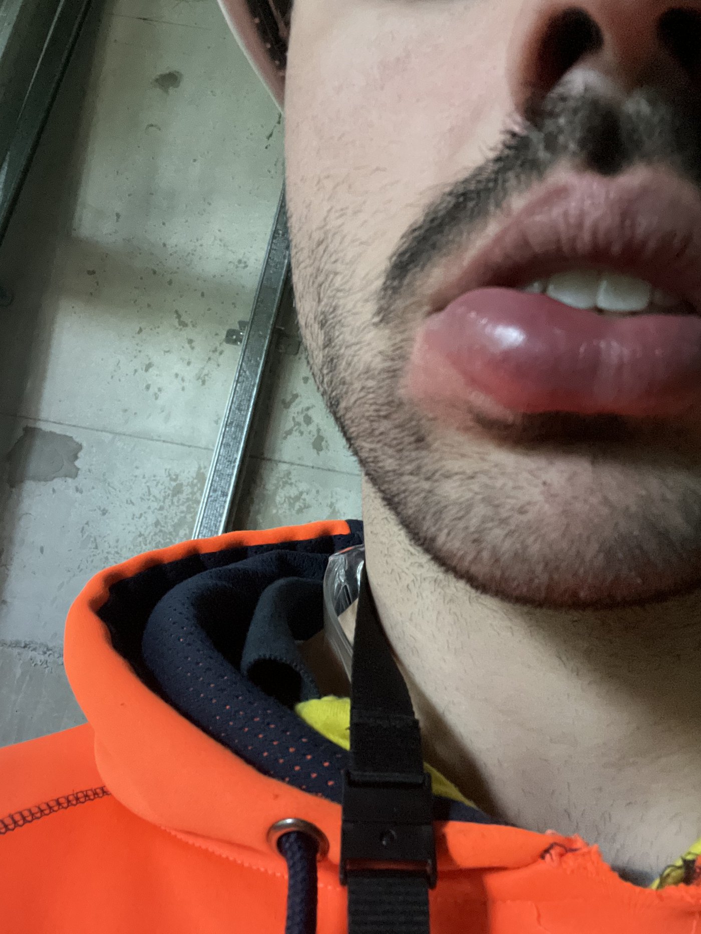 Swollen lips from immune reaction
