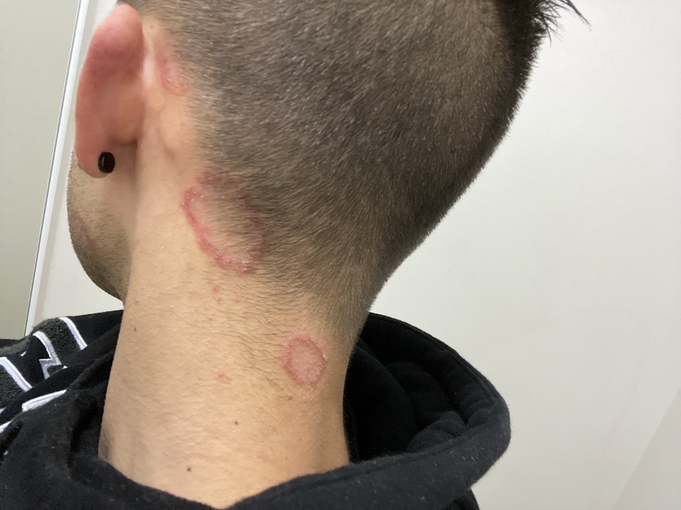 Skin infections on neck from mould exposure